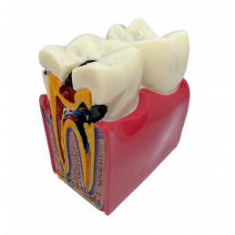 Модель зуба с кариесом (размер 6:1) (1шт)