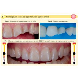 Айгос Юниверсал A3.5 (1 шпр*4 г) цирконосодержащий композит, Ямакин (YAMAKIN iGOS Universal A3.5)