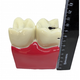 Модель зуба с кариесом (размер 6:1) (1шт)