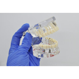 Модель челюсти (типодонт) прозрачная, с разными заболеваниями, имплантами 