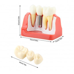Модель зубов с Имплантом (размер 6:1) (1шт)