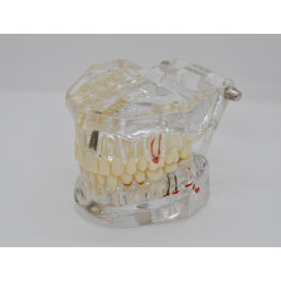 Модель челюсти (типодонт) прозрачная, с разными заболеваниями, имплантами 
