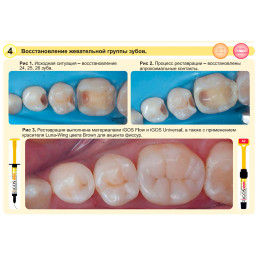 Айгос Юниверсал A3.5 (1 шпр*4 г) цирконосодержащий композит, Ямакин (YAMAKIN iGOS Universal A3.5)