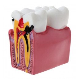 Модель зуба с кариесом (размер 6:1) (1шт)