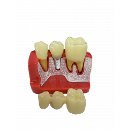 Модель зубов с Имплантом (размер 6:1) (1шт)