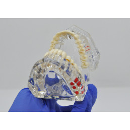 Модель челюсти (типодонт) прозрачная, с разными заболеваниями, имплантами 