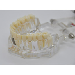 Модель челюсти (типодонт) прозрачная, с разными заболеваниями, имплантами 