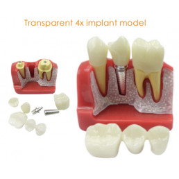 Модель зубов с Имплантом (размер 6:1) (1шт)