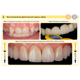 Айгос Флоу OA2 (1 шпр*2,6 г) цирконосодержащий жидкотекучий композит, Ямакин (YAMAKIN iGOS Flow OA2)