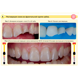 Айгос Юниверсал BW (1 шпр*4 г) цирконосодержащий композит, Ямакин (YAMAKIN iGOS Universal BW)