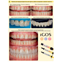 Айгос Флоу A1 (1 шпр*2,6 г) цирконосодержащий жидкотекучий композит, Ямакин (YAMAKIN iGOS Flow A1)