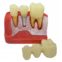 Модель зубов с Имплантом (размер 6:1) (1шт)