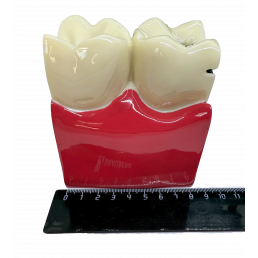 Модель зуба с кариесом (размер 6:1) (1шт)