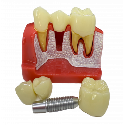 Модель зубов с Имплантом (размер 6:1) (1шт)