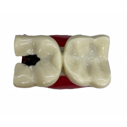 Модель зуба с кариесом (размер 6:1) (1шт)