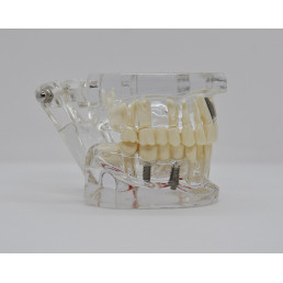 Модель челюсти (типодонт) прозрачная, с разными заболеваниями, имплантами 