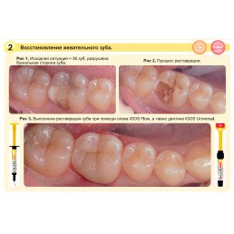 Айгос Юниверсал A3.5 (1 шпр*4 г) цирконосодержащий композит, Ямакин (YAMAKIN iGOS Universal A3.5)
