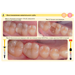 Айгос Юниверсал OA2 (1 шпр*4 г) цирконосодержащий композит, Ямакин (YAMAKIN iGOS Universal OA2)