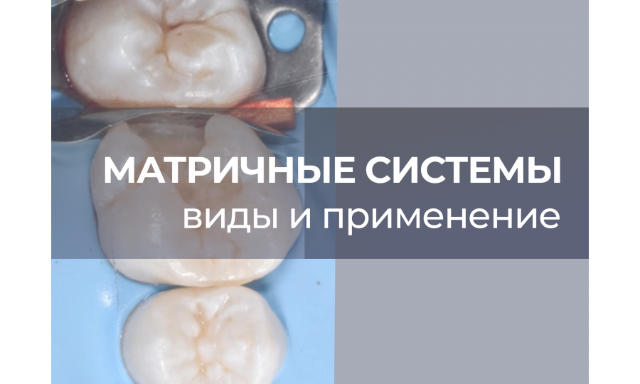 Применение матричных систем в стоматологии
